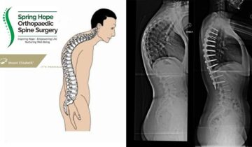 Surgery for Hunched Posture Can Increase Height