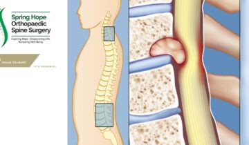 Early Surgery in Spinal Cord Compression from Spine Tumor Gives in Better Outcome