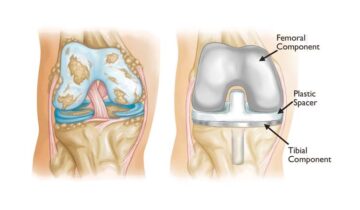 Total Knee Replacement | The Best Operation for Knee Osteoarthritis