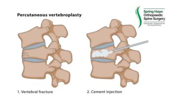 Vertebroplasty | Injection of Cement in Osteoporotic Spine Fracture